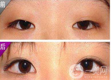 開眼角手術(shù),價格