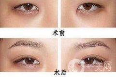 韓式開眼角哪果好？哪個(gè)醫(yī)院做韓式開眼角比較好
