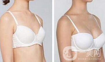 曼托假體豐胸要多少錢？曼托假體豐胸費(fèi)用詳解