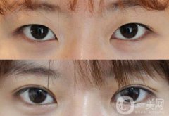 做高分子雙眼皮多少錢？高分子雙眼皮價格介紹