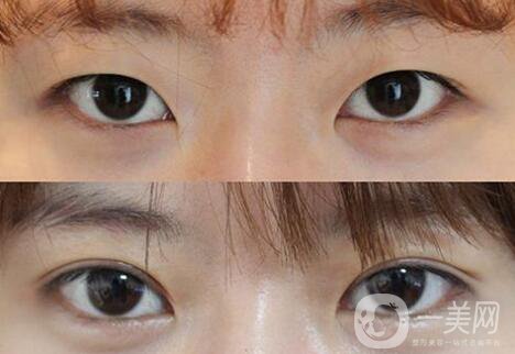 做高分子雙眼皮多少錢？高分子雙眼皮價(jià)格介紹