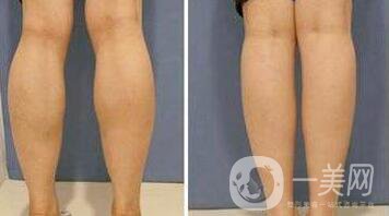 *要多少錢？注射*價(jià)格詳細(xì)介紹