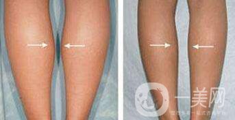 *要多少錢？注射*價(jià)格詳細(xì)介紹