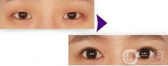 開眼角的果到底怎么樣？開眼角前后圖