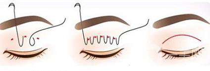 眼睛埋線幾年后的危害有些什么？