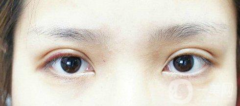 眼睛埋線幾年后的危害有些什么？