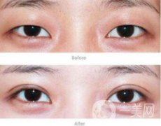 焊接雙眼皮果怎么樣？焊接雙眼皮有什么缺點