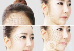 *面部提升術詳細介紹？*果怎么樣