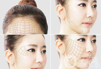 *面部提升術(shù)詳細(xì)介紹？**果怎么樣