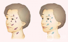 小切口拉皮除皺術(shù)果一般能維持幾年？