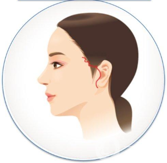 小切口拉皮除皺術(shù)*果一般能維持幾年？