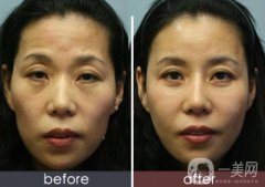 自體脂肪臉部填充果可以維持多久？