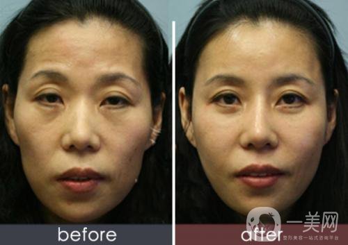 自體脂肪臉部填充*果可以維持多久？