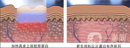 做像素激光調(diào)節(jié)痘疤一般多少錢？