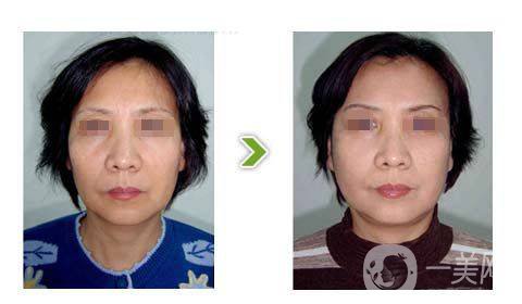 光子嫩膚的*果前后有什么變化？