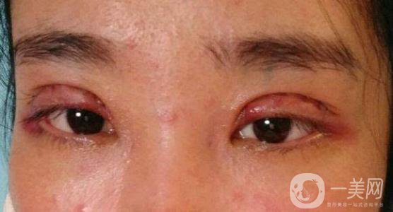 做完韓式三點(diǎn)雙眼皮之后眼睛會(huì)腫嗎？