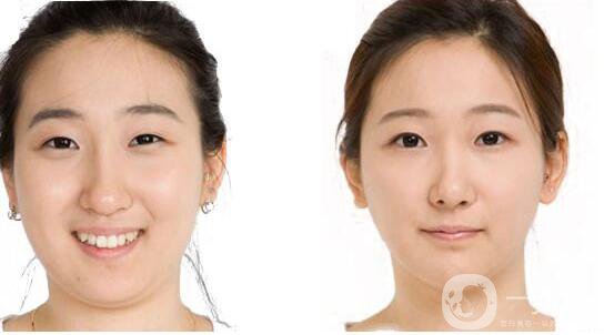 去頰脂墊瘦臉,價格