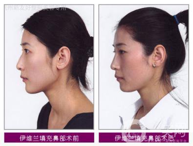 伊維蘭除皺多少錢 價(jià)格是多少？