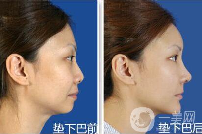 墊下巴,恢復(fù)時(shí)間