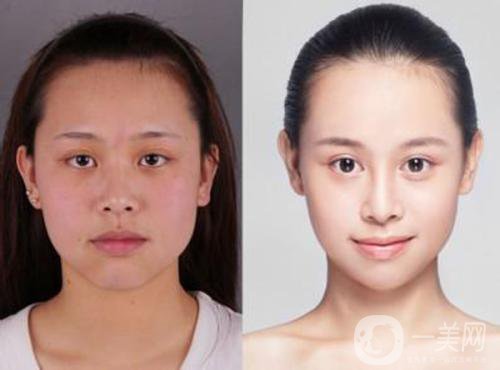 微創(chuàng)改臉型多少錢 費(fèi)用詳情介紹
