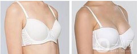 內(nèi)窺鏡隆胸,多少錢