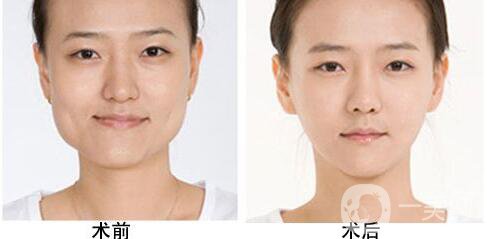 磨下頜角,價(jià)格