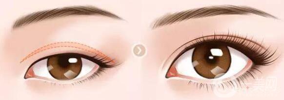 上瞼下垂矯正手術(shù)要多少錢？