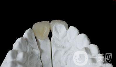 美容冠多少錢 價(jià)格詳情介紹