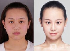 改臉型手術(shù)一般多少錢 價格詳情