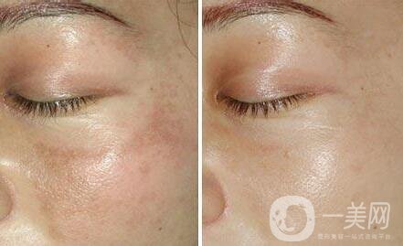 如何去蝴蝶斑、去蝴蝶斑用什么方法好？