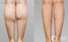 詳細(xì)介紹注射瘦臉注射瘦腿到底有沒有副作用