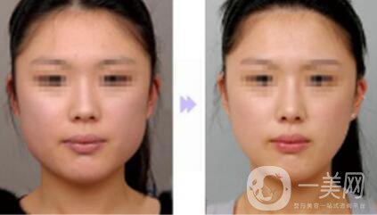 切咬肌多少錢？還會(huì)長出來嗎？