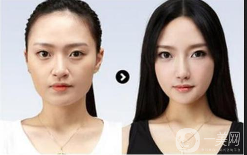 做完墊鼻梁硅膠*果能堅(jiān)持幾年？