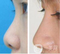 耳軟骨墊鼻尖手術(shù)做完需要多久恢復(fù)正常？