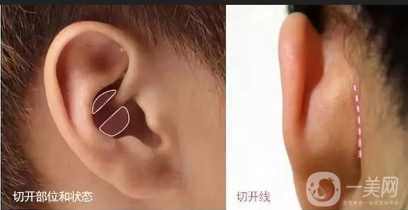 耳軟骨墊鼻尖手術(shù)做完需要多久恢復(fù)正常？