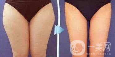 溶脂減肥手術(shù)的價(jià)格一般多少錢(qián)？