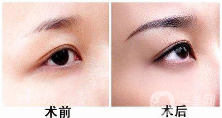 廣東玻尿酸豐眉弓手術費用 價格詳情一覽