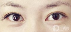 不開刀的雙眼皮是*的嗎？