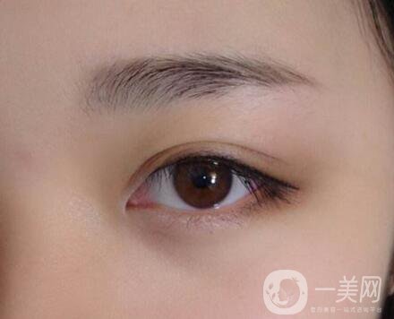 不開(kāi)刀的雙眼皮是*的嗎？