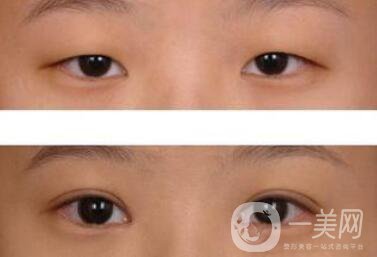 威海割雙眼皮多少錢？雙眼皮手術(shù)價格詳解