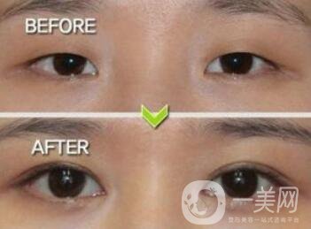 威海割雙眼皮多少錢？雙眼皮手術(shù)價格詳解