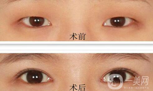 韓式*開眼角多少錢  韓式*開眼角恢復(fù)圖