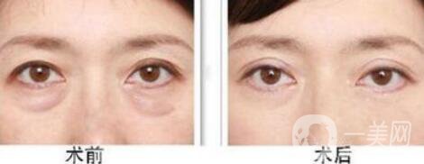 超聲法去眼袋怎么樣 超聲法祛眼袋多少錢(qián)