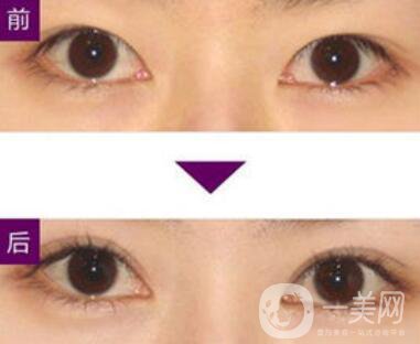 三點定位雙眼皮手術(shù)有副作用嗎、*果怎么樣