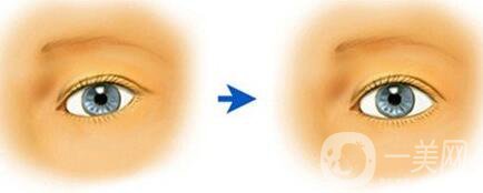 眼瞼下至老了會怎么樣？眼瞼下至多少錢