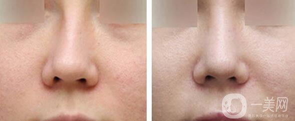 矯正鼻子大概多少錢？矯正鼻子多少費(fèi)用詳情