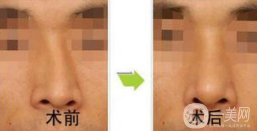 矯正鼻子大概多少錢？矯正鼻子多少費(fèi)用詳情