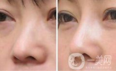 上海縮小鼻頭手術多少錢 縮小鼻頭整形價格介紹