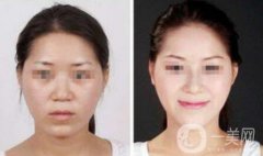 注射隆鼻一般多少錢？廣東隆鼻注射價格介紹