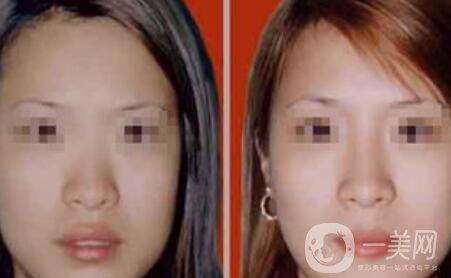 注射隆鼻一般多少錢？廣東隆鼻注射價(jià)格介紹